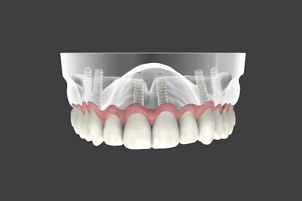 Are Implant Supported Dentures Permanent from Fort Lee Family Dental in Fort Lee, NJ