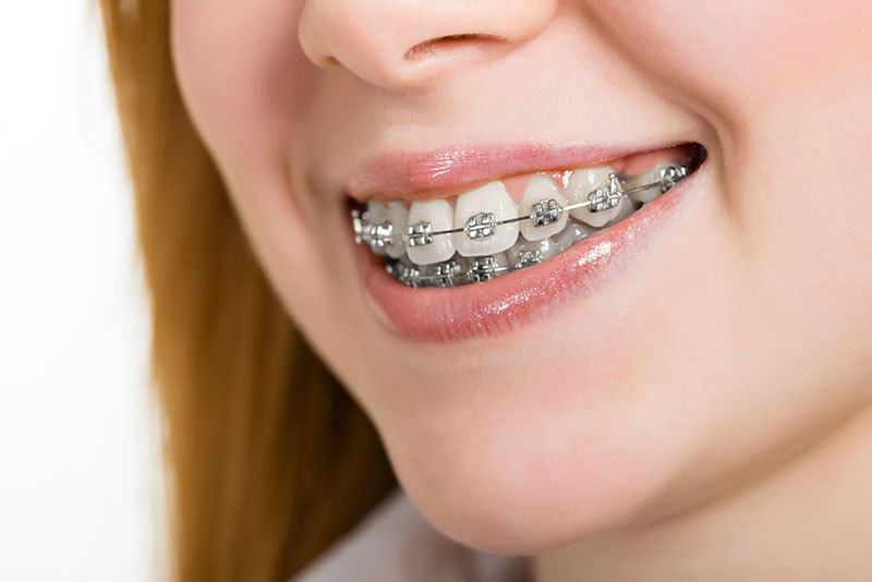 Difference Between Retainers and Dental Braces