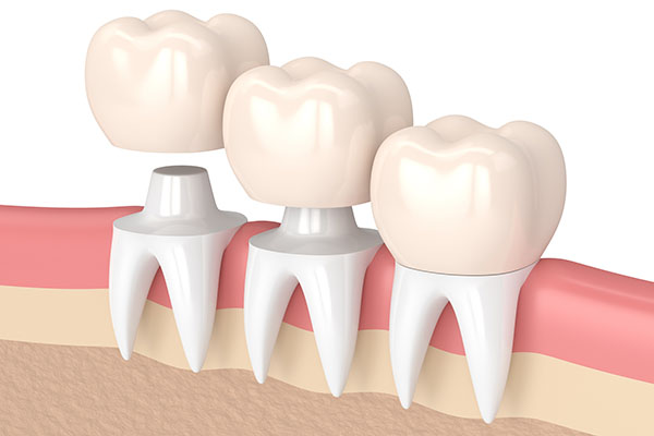 Three Tips to Deal With a Loose Dental Crown from Fort Lee Family Dental in Fort Lee, NJ