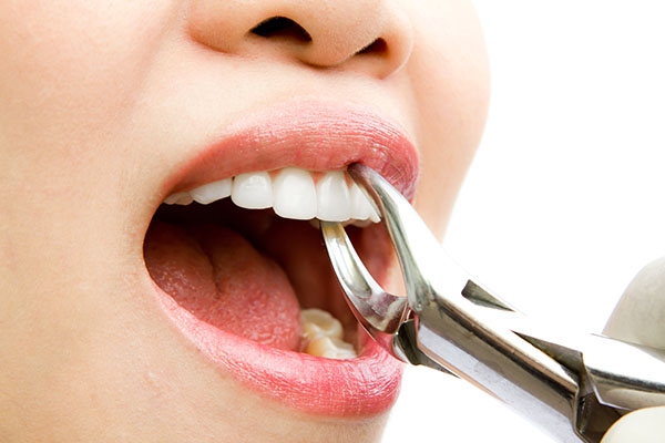What You Need To Know About Dental Extractions