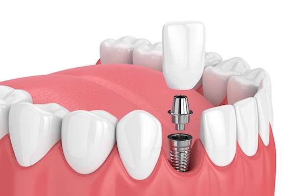 How Painful is Dental Implant Surgery from Fort Lee Family Dental in Fort Lee, NJ
