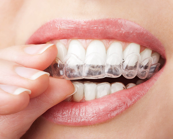 Invisalign Braces: The Facts You Want To Know