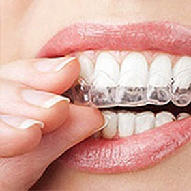 Clear Braces Wall Twp NJ  Straighten Teeth with Invisalign Clear Aligners