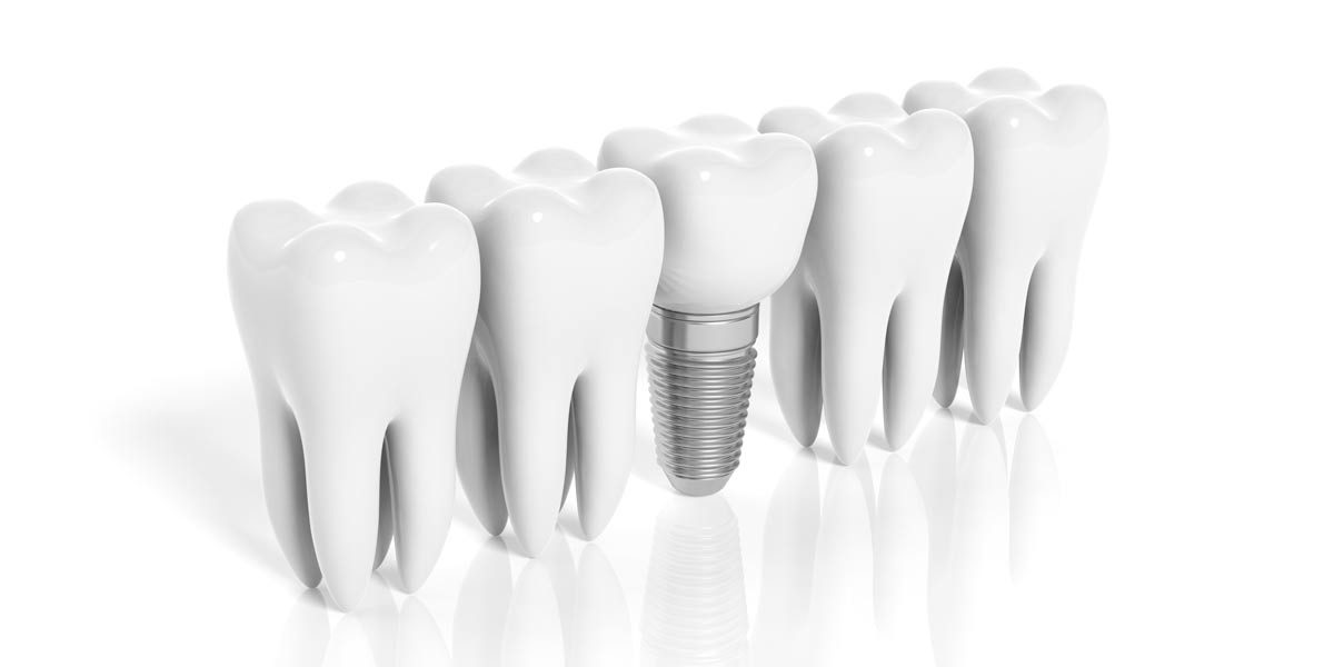 Fort Lee Post-Op Care for Dental Implants