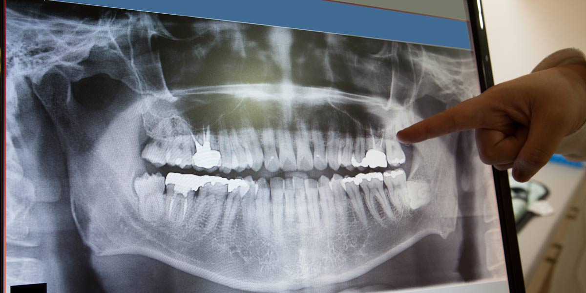 Fort Lee Wisdom Teeth Extraction
